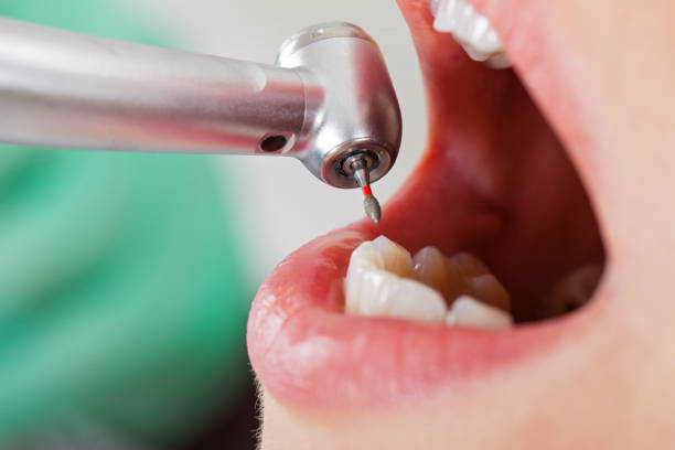 Best Emergency Tooth Extraction in Monticello, IA